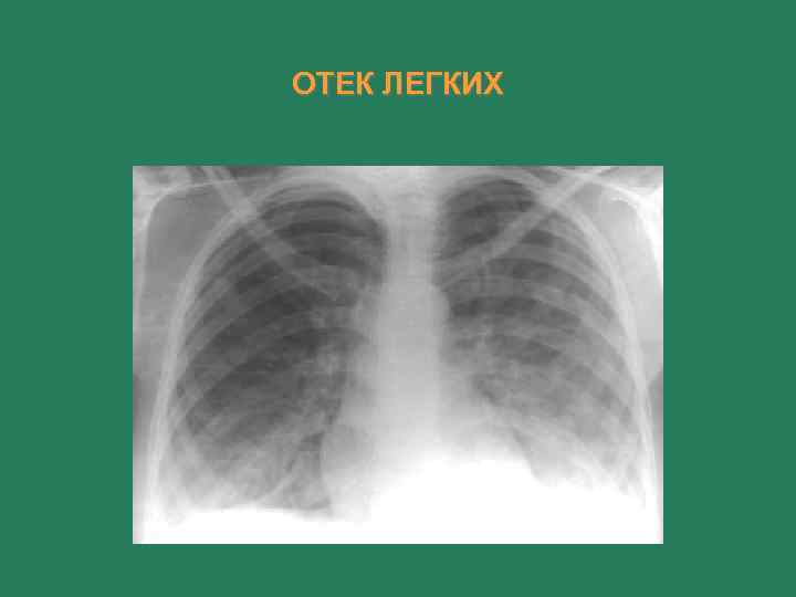 ОТЕК ЛЕГКИХ 