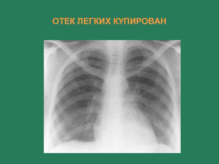 ОТЕК ЛЕГКИХ КУПИРОВАН 