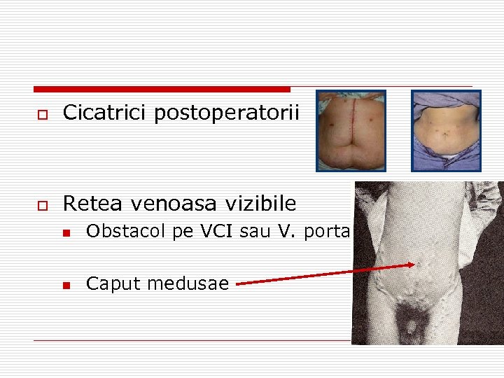 o Cicatrici postoperatorii o Retea venoasa vizibile n Obstacol pe VCI sau V. porta