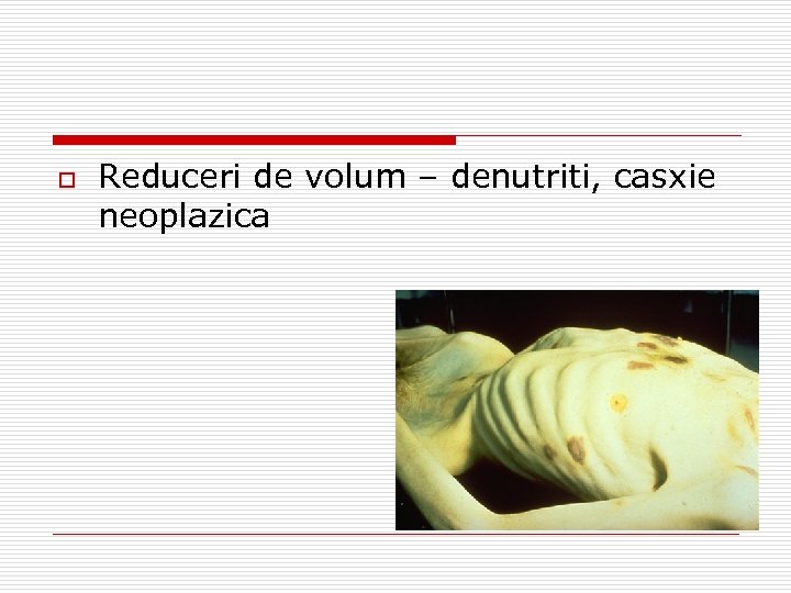 o Reduceri de volum – denutriti, casxie neoplazica 