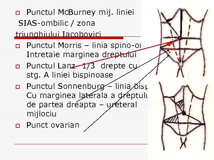 Punctul Mc. Burney mij. liniei SIAS-ombilic / zona triunghiului Iacobovici o Punctul Morris –