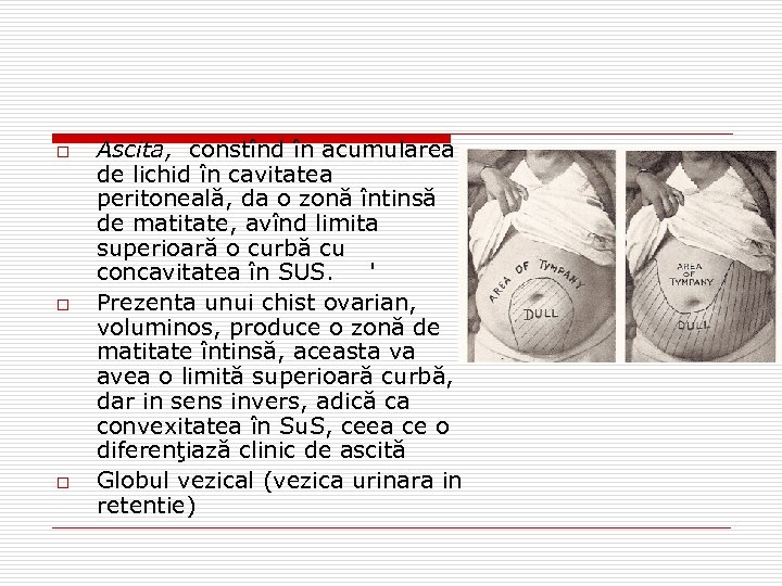 o o o Ascita, constînd în acumularea de lichid în cavitatea peritoneală, da o