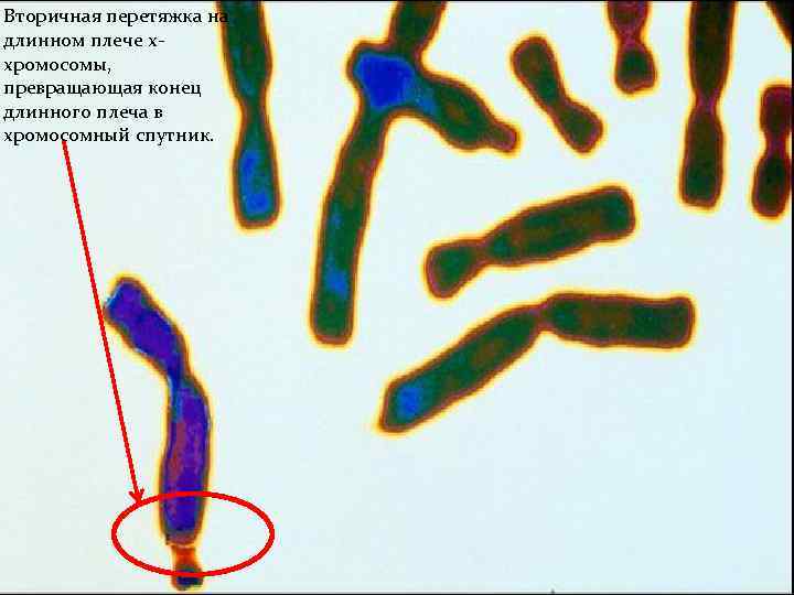 Вторичная перетяжка на длинном плече ххромосомы, превращающая конец длинного плеча в хромосомный спутник. 