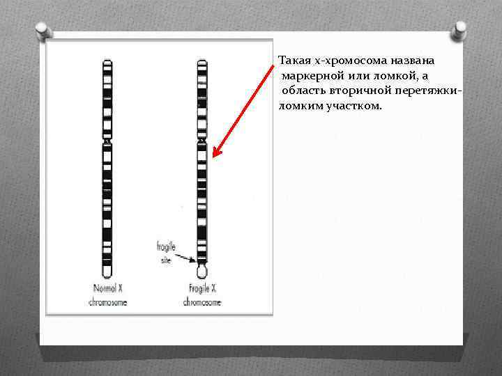 Такая х-хромосома названа маркерной или ломкой, а область вторичной перетяжкиломким участком. 