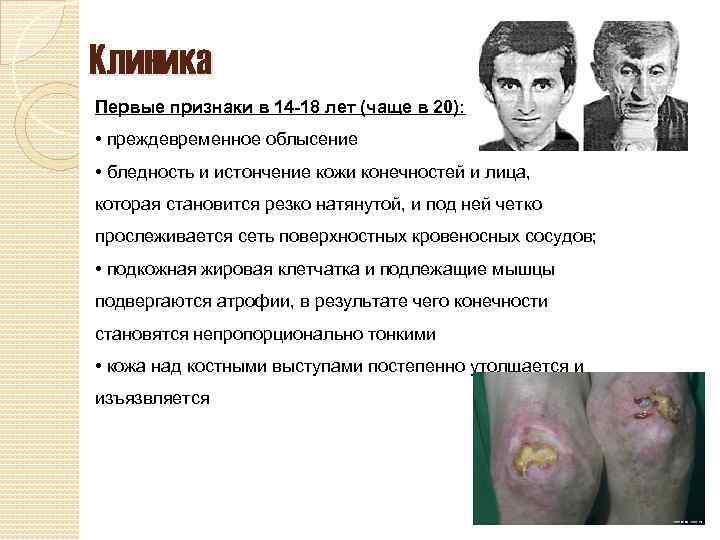 Клиника Первые признаки в 14 -18 лет (чаще в 20): • преждевременное облысение •