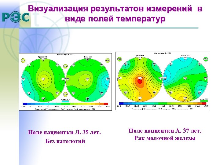 Визуализация результатов измерений в виде полей температур Поле пациентки Л. 35 лет. Без патологий