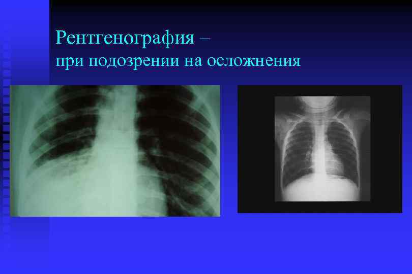 Рентгенография – при подозрении на осложнения 