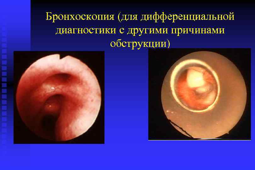 Бронхоскопия (для дифференциальной диагностики с другими причинами обструкции) 