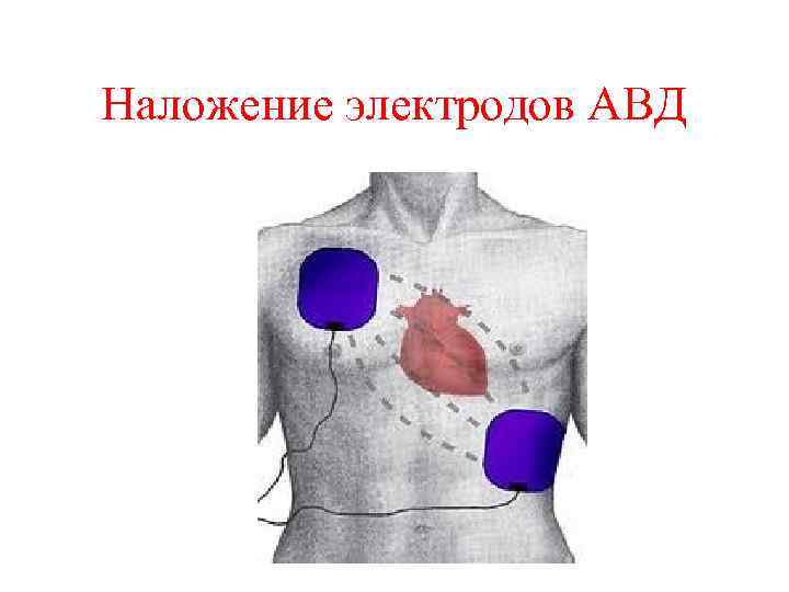 Наложение электродов АВД 