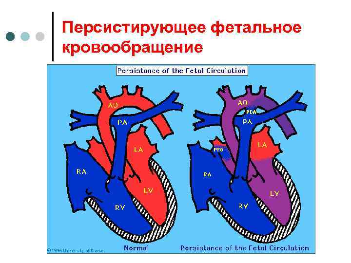 Персистирующее фетальное кровообращение 