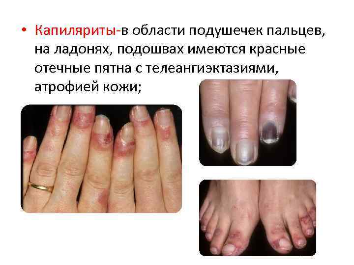  • Капиляриты в области подушечек пальцев, на ладонях, подошвах имеются красные отечные пятна