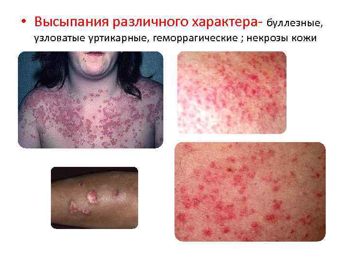  • Высыпания различного характера буллезные, узловатые уртикарные, геморрагические ; некрозы кожи 