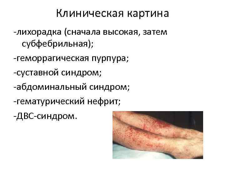 Клиническая картина -лихорадка (сначала высокая, затем субфебрильная); -геморрагическая пурпура; -суставной синдром; -абдоминальный синдром; -гематурический