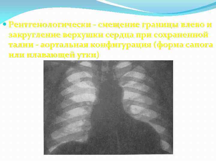  Рентгенологически - смещение границы влево и закругление верхушки сердца при сохраненной талии -
