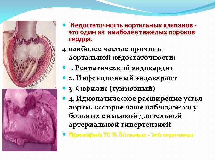  Недостаточность аортальных клапанов это один из наиболее тяжелых пороков сердца. 4 наиболее частые