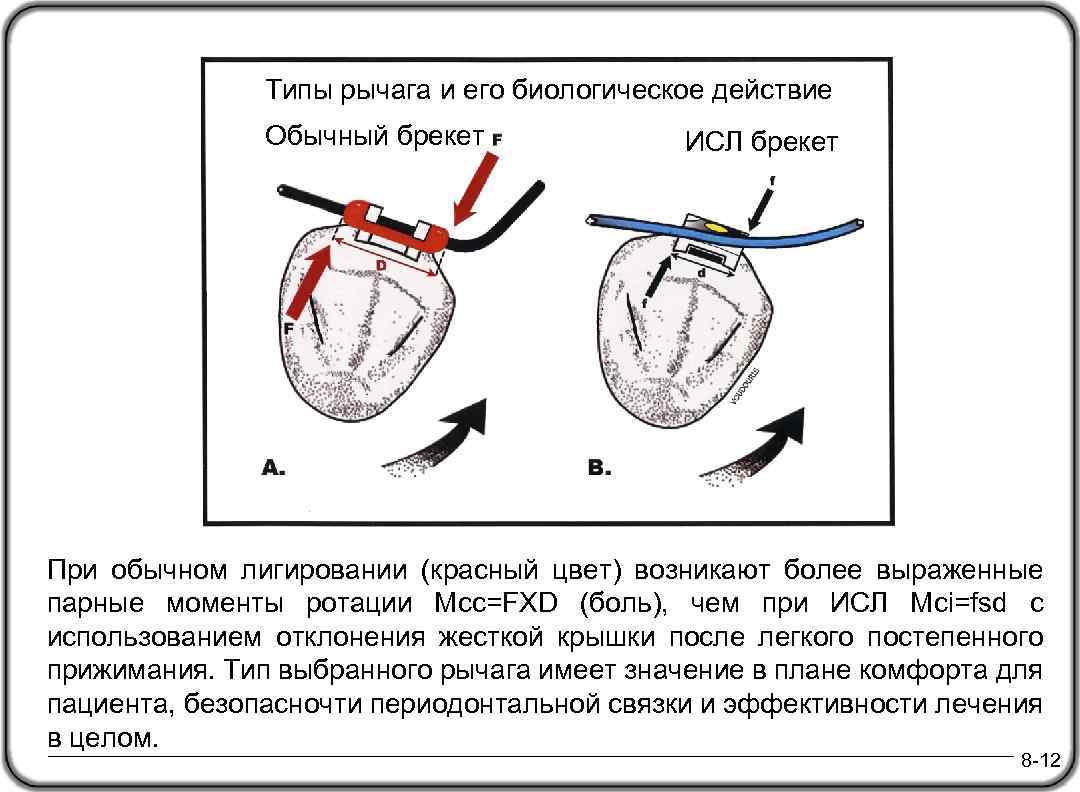 Типы рычага и его биологическое действие Обычный брекет ИСЛ брекет При обычном лигировании (красный