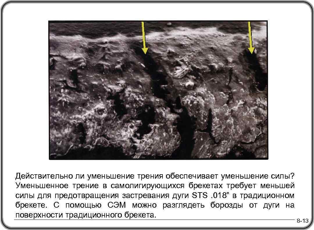 Действительно ли уменьшение трения обеспечивает уменьшение силы? Уменьшенное трение в самолигирующихся брекетах требует меньшей