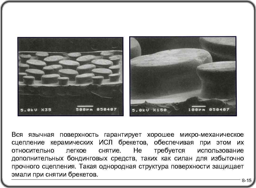Вся язычная поверхность гарантирует хорошее микро-механическое сцепление керамических ИСЛ брекетов, обеспечивая при этом их