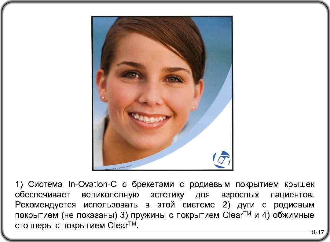 1) Система In-Ovation-C с брекетами с родиевым покрытием крышек обеспечивает великолепную эстетику для взрослых