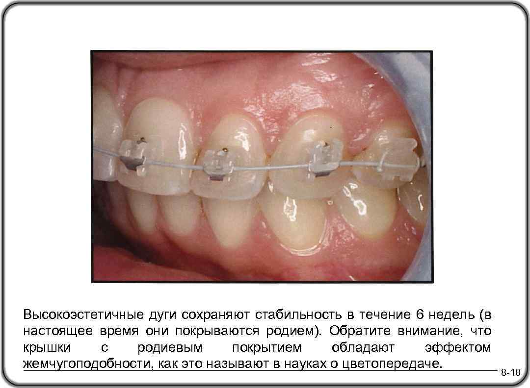 Высокоэстетичные дуги сохраняют стабильность в течение 6 недель (в настоящее время они покрываются родием).