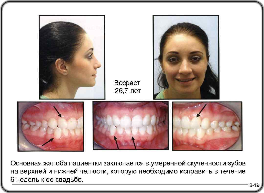 Возраст 26, 7 лет Основная жалоба пациентки заключается в умеренной скученности зубов на верхней