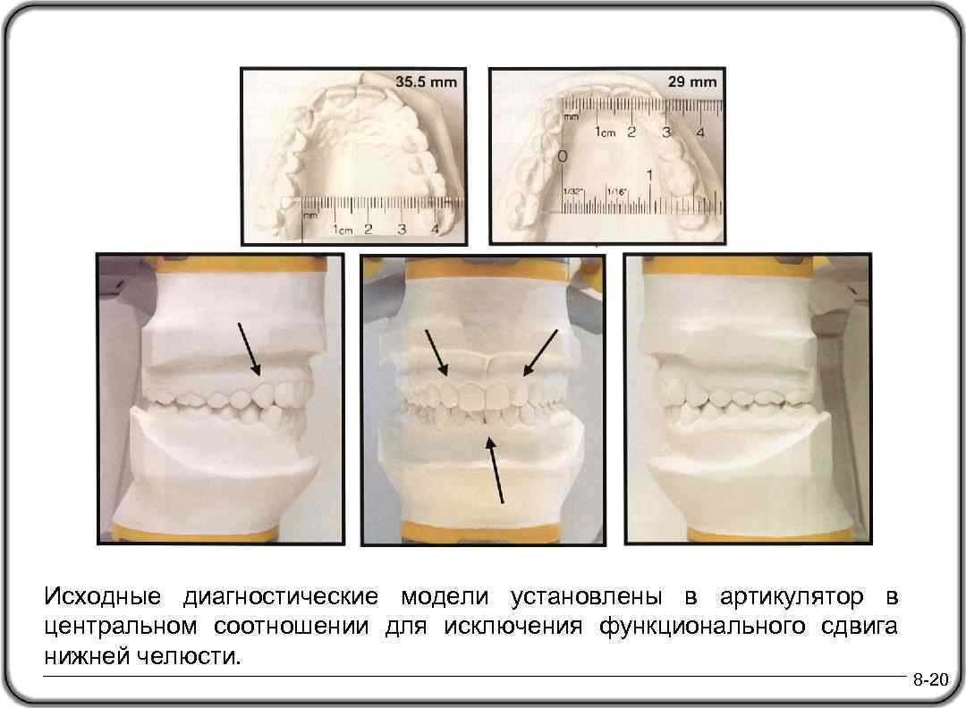 Исходные диагностические модели установлены в артикулятор в центральном соотношении для исключения функционального сдвига нижней