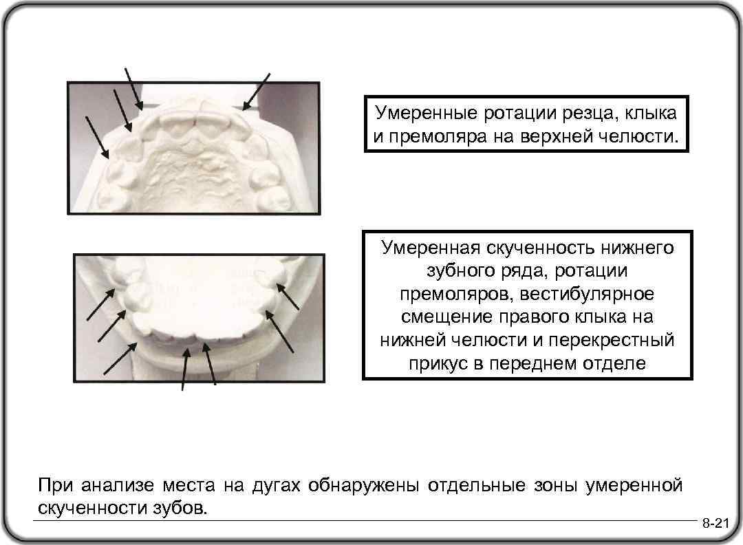 Умеренные ротации резца, клыка и премоляра на верхней челюсти. Умеренная скученность нижнего зубного ряда,