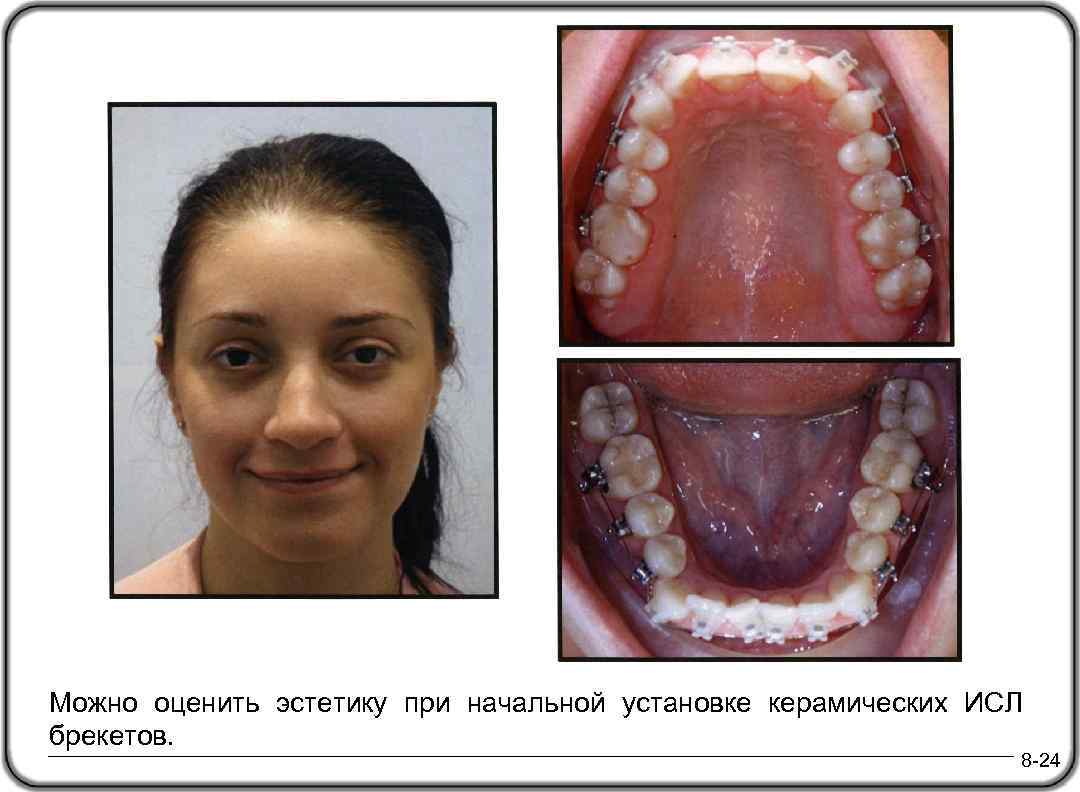 Можно оценить эстетику при начальной установке керамических ИСЛ брекетов. 8 -24 
