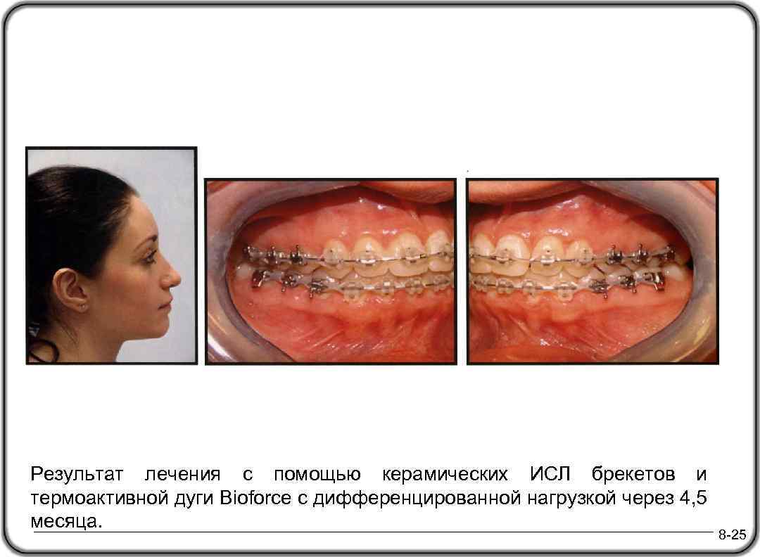 Результат лечения с помощью керамических ИСЛ брекетов и термоактивной дуги Bioforce с дифференцированной нагрузкой