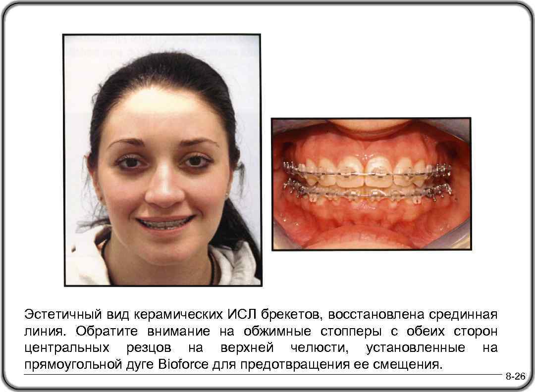 Эстетичный вид керамических ИСЛ брекетов, восстановлена срединная линия. Обратите внимание на обжимные стопперы с