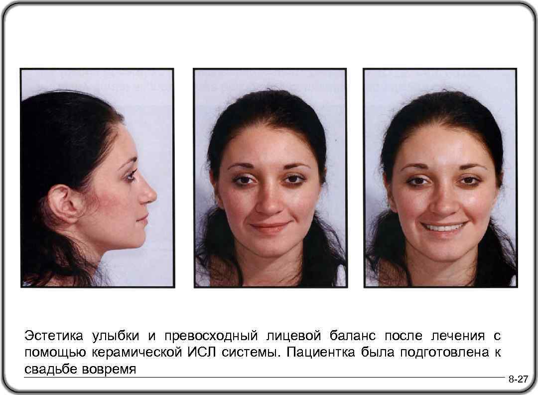 Эстетика улыбки и превосходный лицевой баланс после лечения с помощью керамической ИСЛ системы. Пациентка