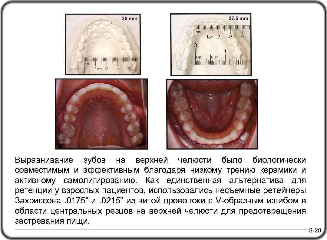 Выравнивание зубов на верхней челюсти было биологически совместимым и эффективным благодаря низкому трению керамики