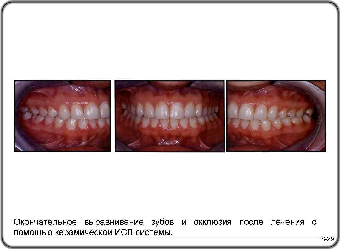 Окончательное выравнивание зубов и окклюзия после лечения с помощью керамической ИСЛ системы. 8 -29