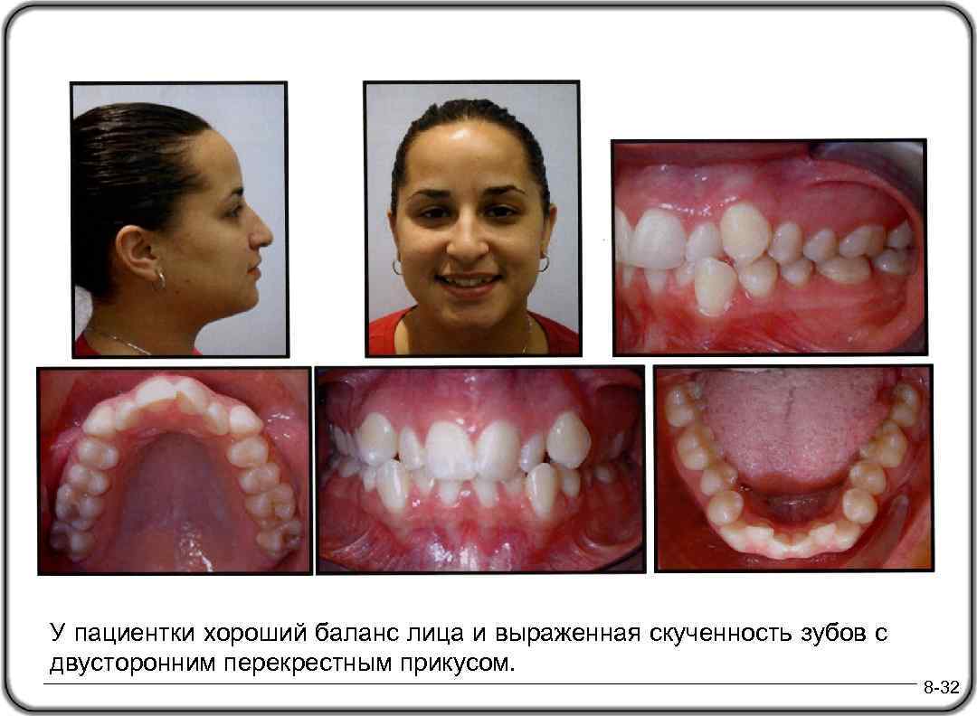 У пациентки хороший баланс лица и выраженная скученность зубов с двусторонним перекрестным прикусом. 8