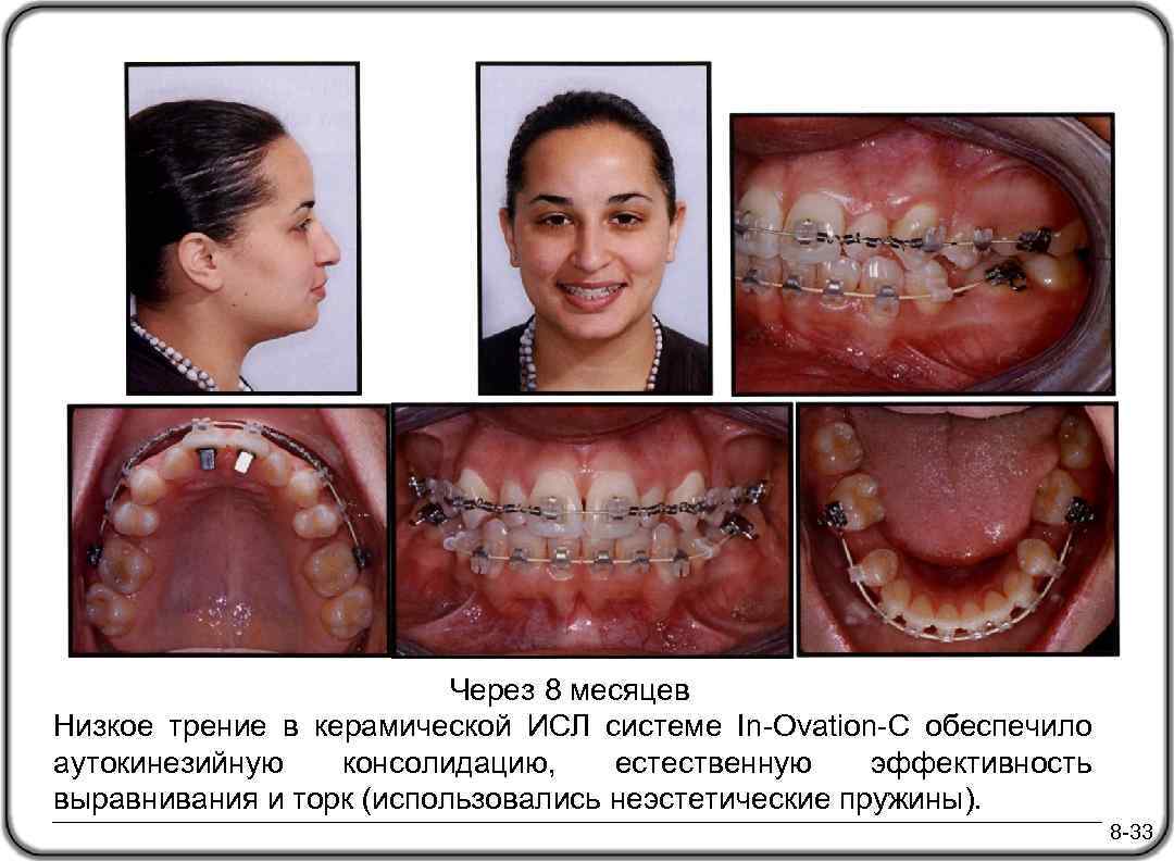  Через 8 месяцев Низкое трение в керамической ИСЛ системе In-Ovation-C обеспечило аутокинезийную консолидацию,