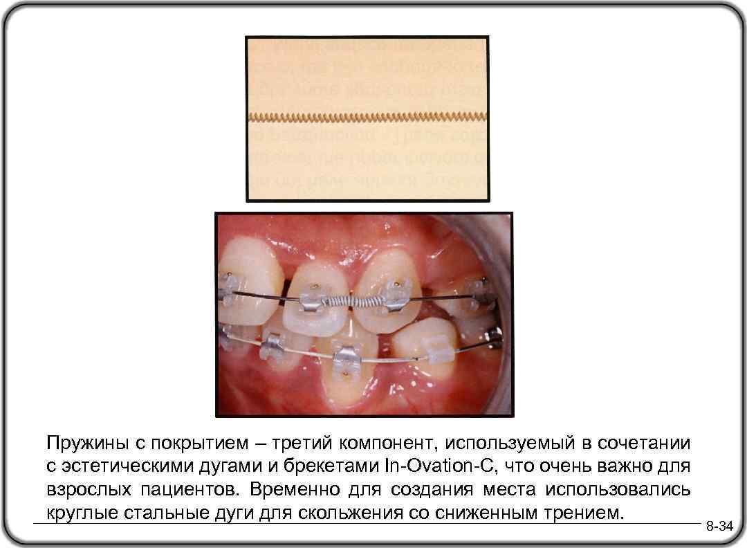 Пружины с покрытием – третий компонент, используемый в сочетании с эстетическими дугами и брекетами
