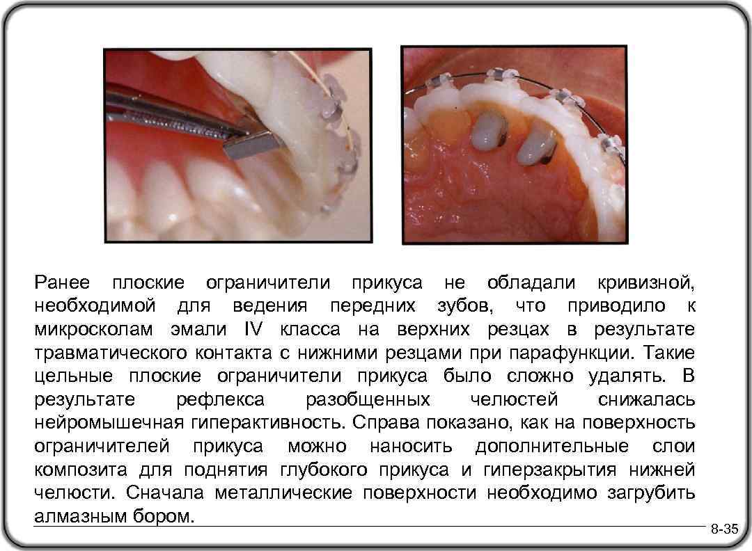 Ранее плоские ограничители прикуса не обладали кривизной, необходимой для ведения передних зубов, что приводило