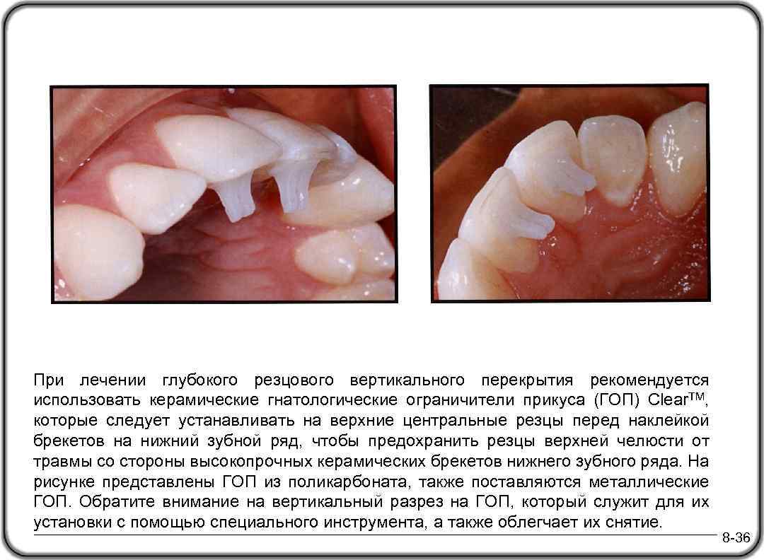 При лечении глубокого резцового вертикального перекрытия рекомендуется использовать керамические гнатологические ограничители прикуса (ГОП) Clear.