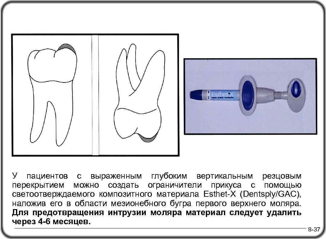  У пациентов с выраженным глубоким вертикальным резцовым перекрытием можно создать ограничители прикуса с