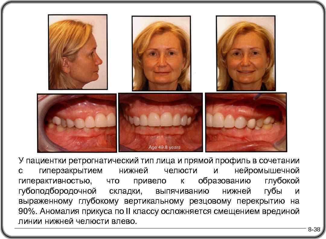 Возраст 49, 8 лет У пациентки ретрогнатический тип лица и прямой профиль в сочетании