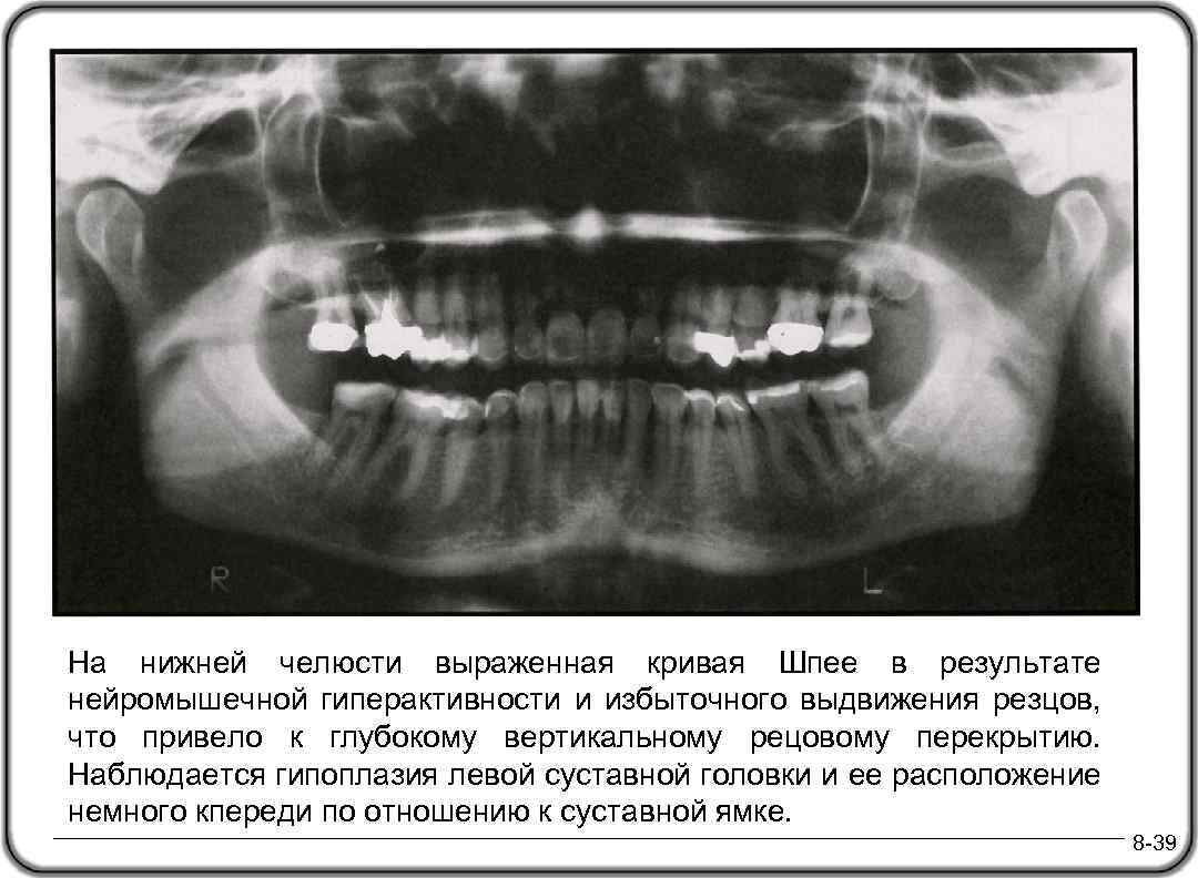 На нижней челюсти выраженная кривая Шпее в результате нейромышечной гиперактивности и избыточного выдвижения резцов,