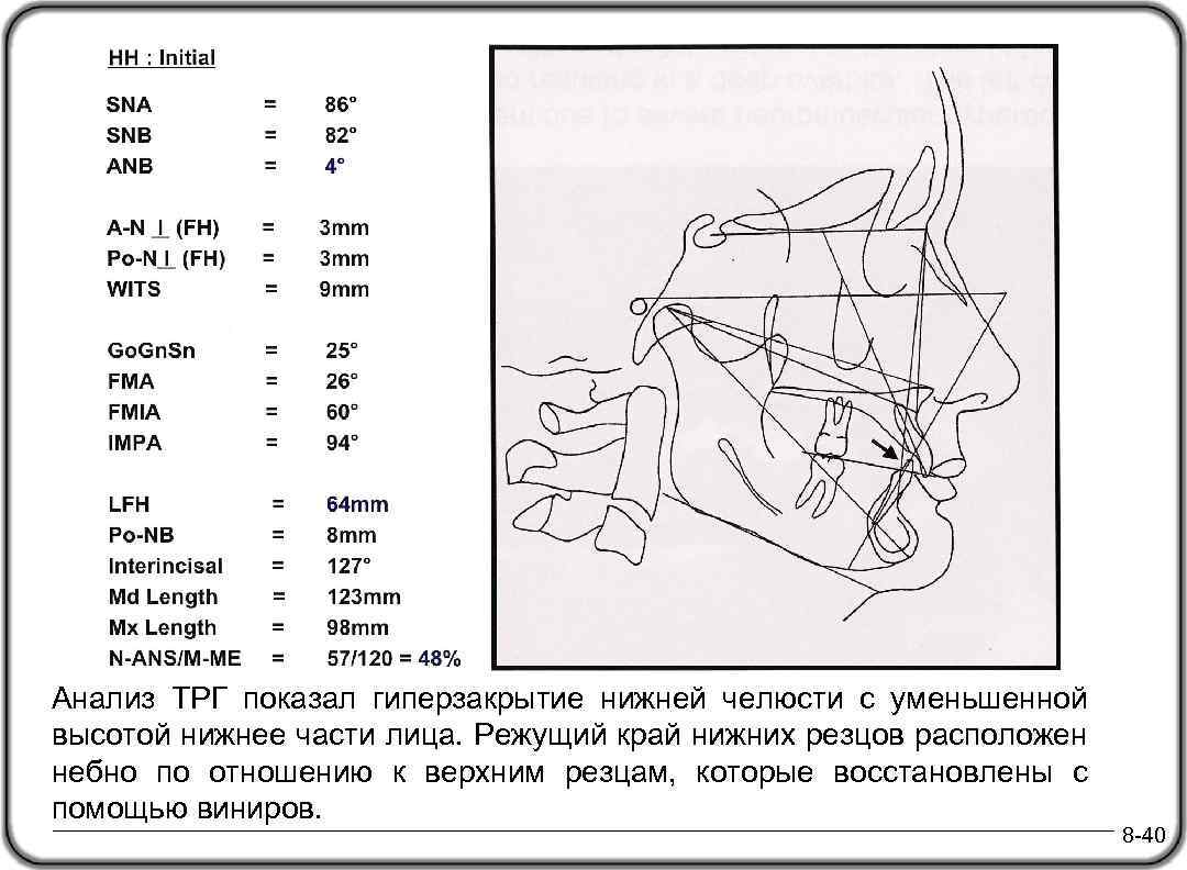 Анализ ТРГ показал гиперзакрытие нижней челюсти с уменьшенной высотой нижнее части лица. Режущий край