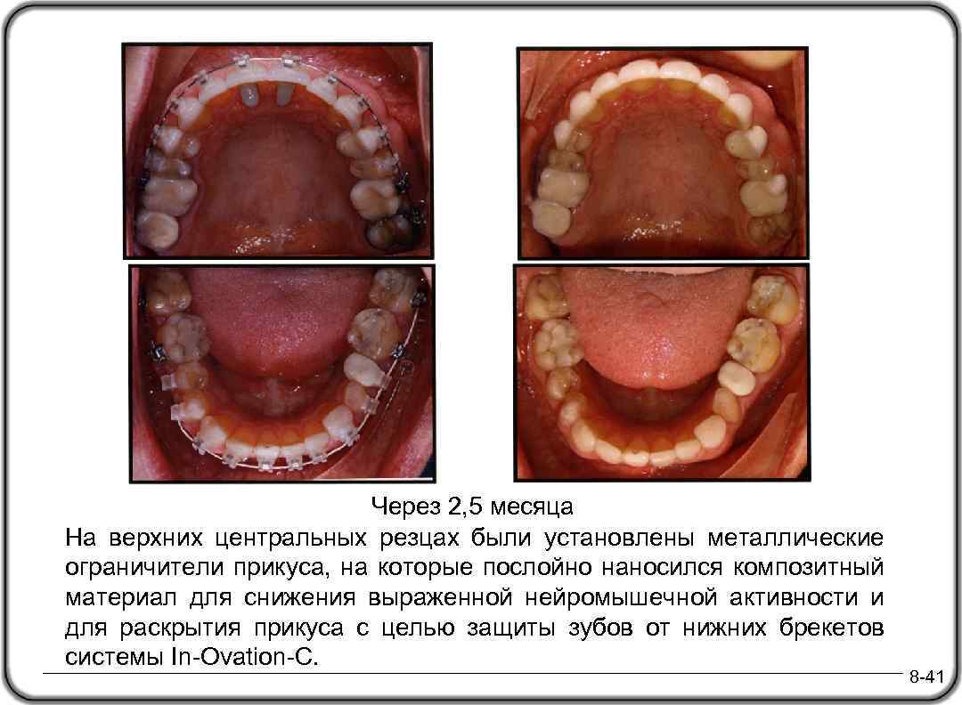 Через 2, 5 месяца На верхних центральных резцах были установлены металлические ограничители прикуса, на