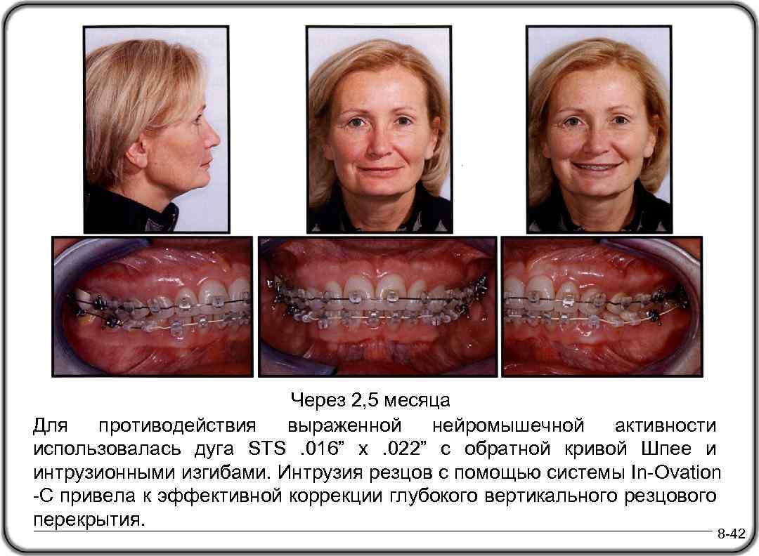 Через 2, 5 месяца Для противодействия выраженной нейромышечной активности использовалась дуга STS . 016”