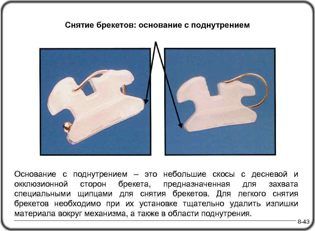 Снятие брекетов: основание с поднутрением Основание с поднутрением – это небольшие скосы с десневой