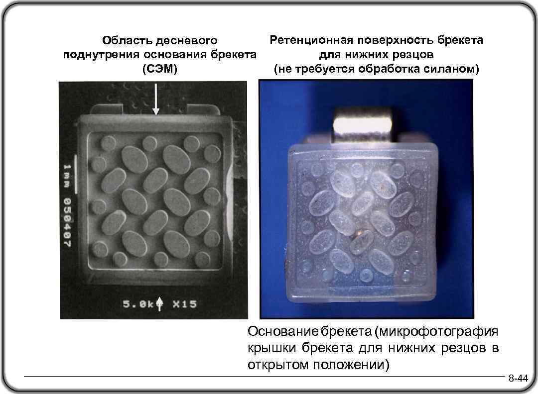 Ретенционные аппараты презентация