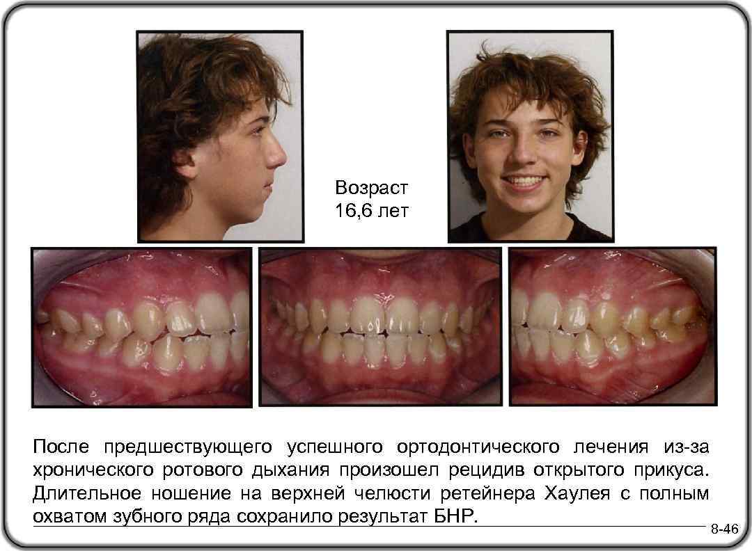 Возраст 16, 6 лет После предшествующего успешного ортодонтического лечения из-за хронического ротового дыхания произошел