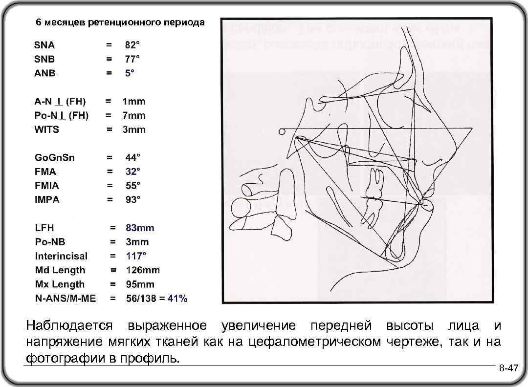6 месяцев ретенционного периода Наблюдается выраженное увеличение передней высоты лица и напряжение мягких тканей