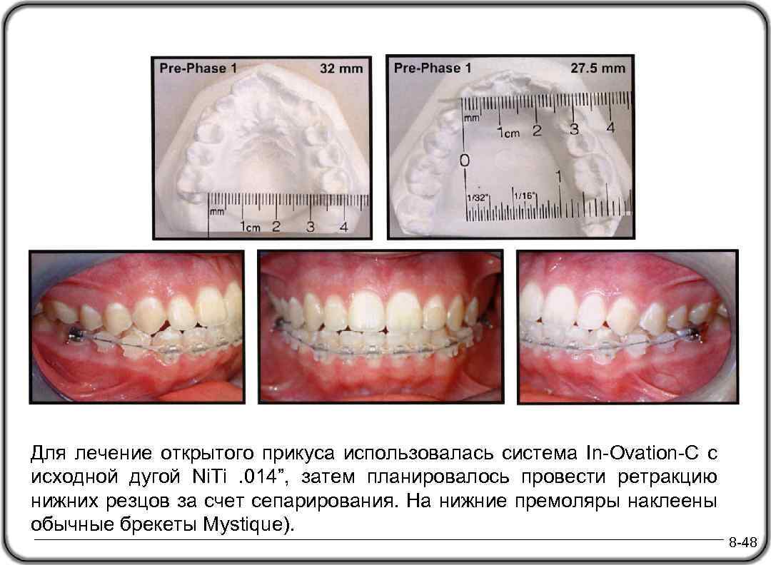 Для лечение открытого прикуса использовалась система In-Ovation-C с исходной дугой Ni. Ti . 014”,