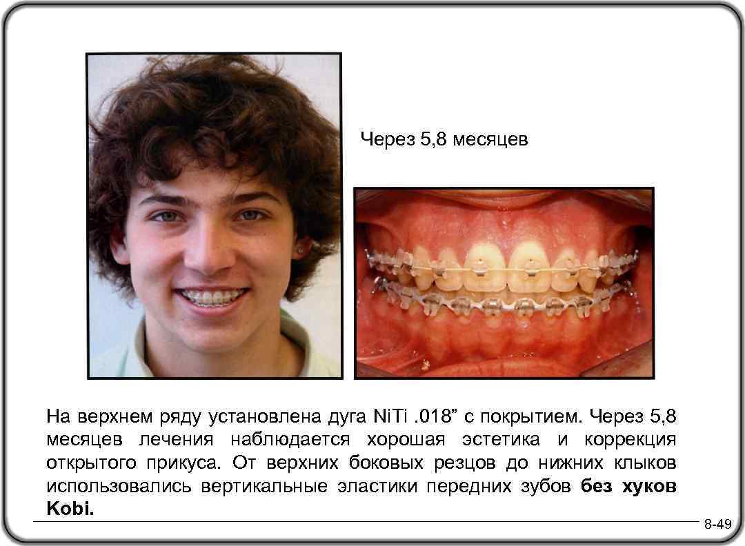 Через 5, 8 месяцев На верхнем ряду установлена дуга Ni. Ti. 018” с покрытием.